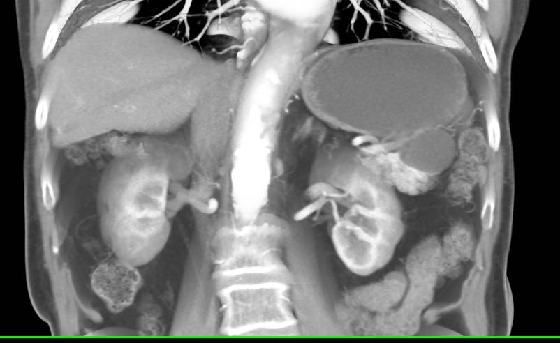 Mucinous Cystic Neoplasm (MCN) of the Tail of the Pancreas - CTisus CT Scan
