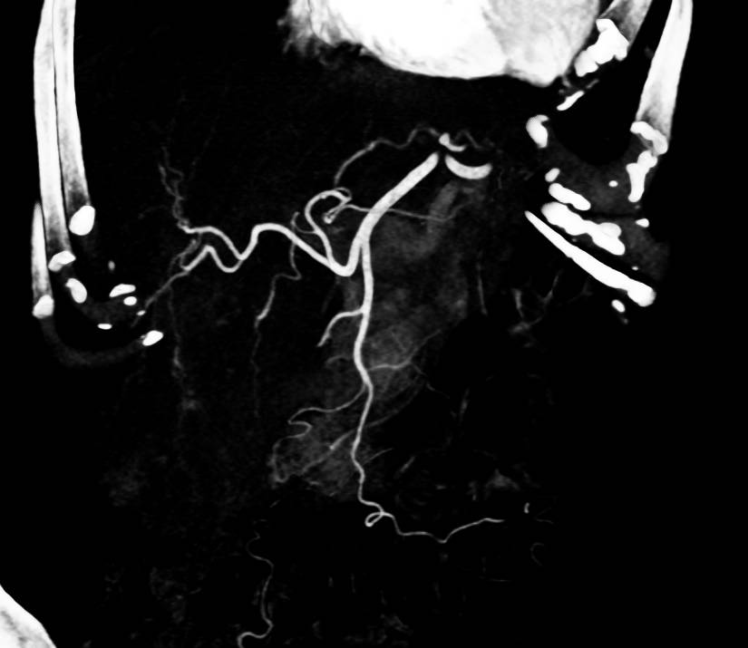 Atrophic Pancreas - CTisus CT Scan
