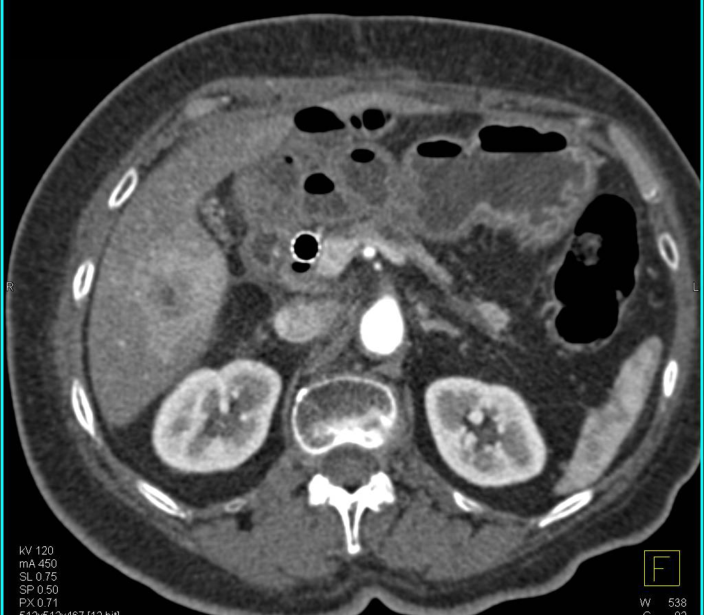Pancreatic Cancer with Variant Vascular Anatomy - CTisus CT Scan