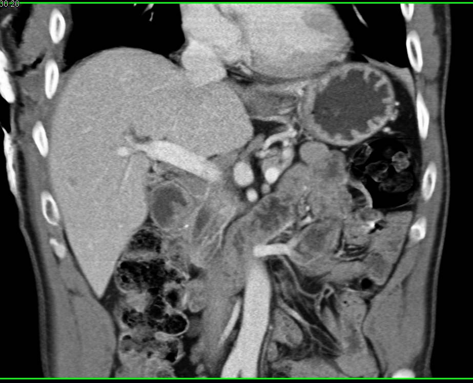Double Duct Sign - CTisus CT Scan