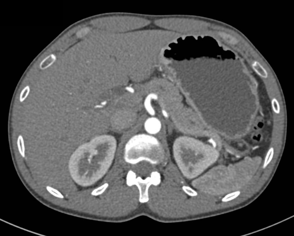 Incredible Case of Groove Pancreatitis - CTisus CT Scan