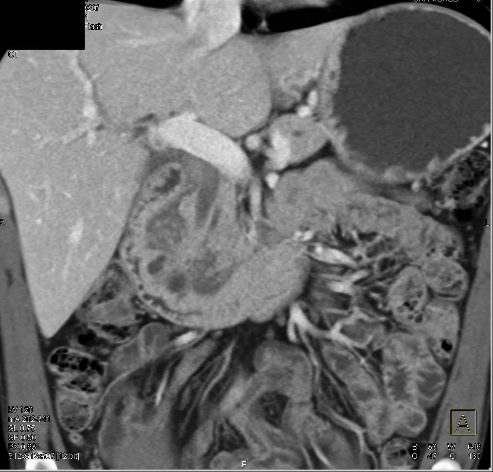 Groove Pancreatitis - CTisus CT Scan