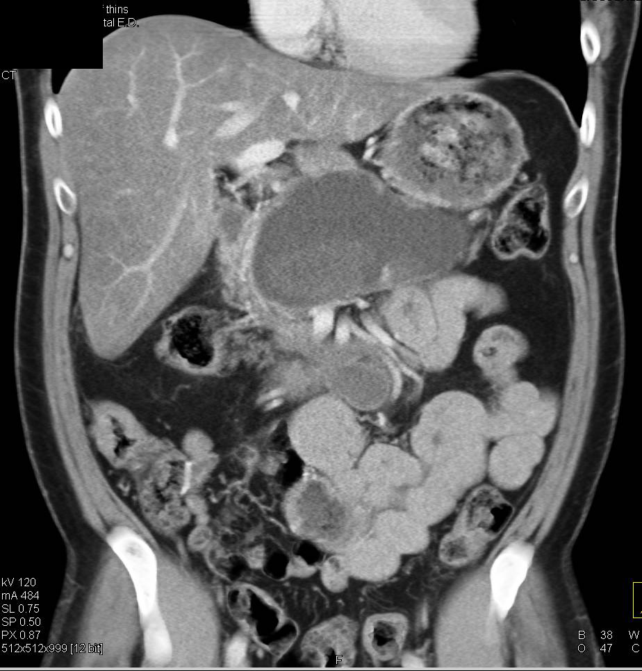 Pseudocyst with Splenic Vein Occlusion - CTisus CT Scan