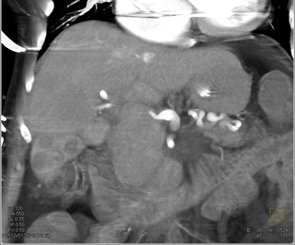 Pancreatic Adenocarcinoma - CTisus CT Scan