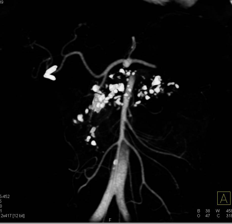 Chronic Pancreatitis with Glandular Calcifications - CTisus CT Scan