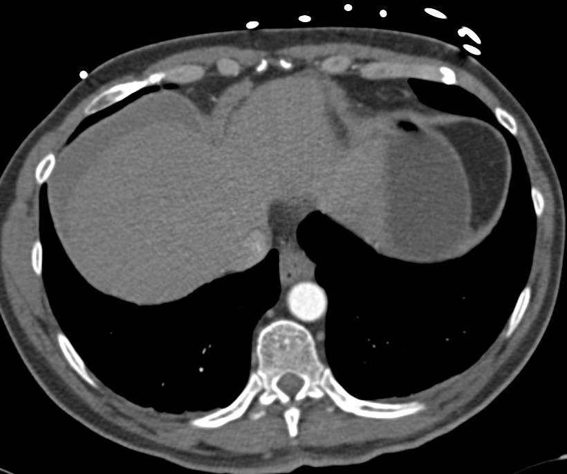 Acute Pancreatitis Plus Hemorrhage Following Trauma (MVA) - CTisus CT Scan
