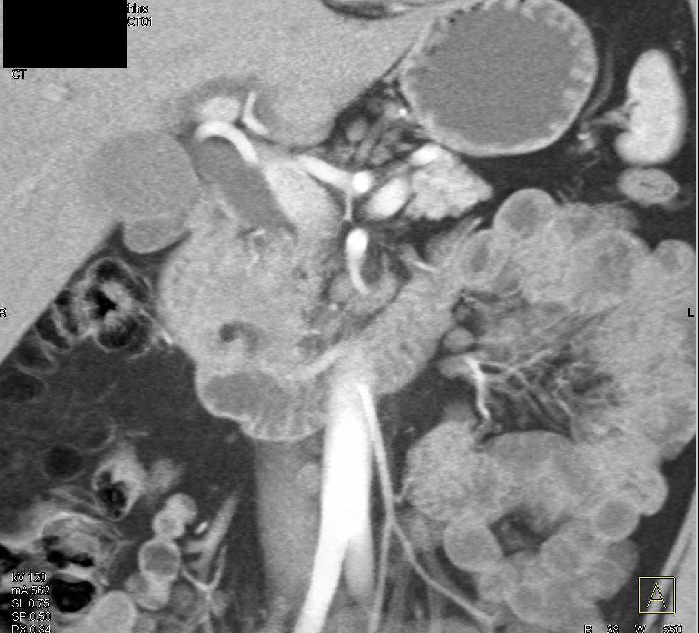 Ampullary Carcinoma Seen Well in 3D - CTisus CT Scan