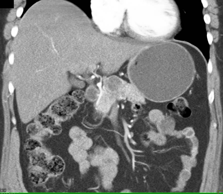 Atypical Serous Cystadenoma - CTisus CT Scan