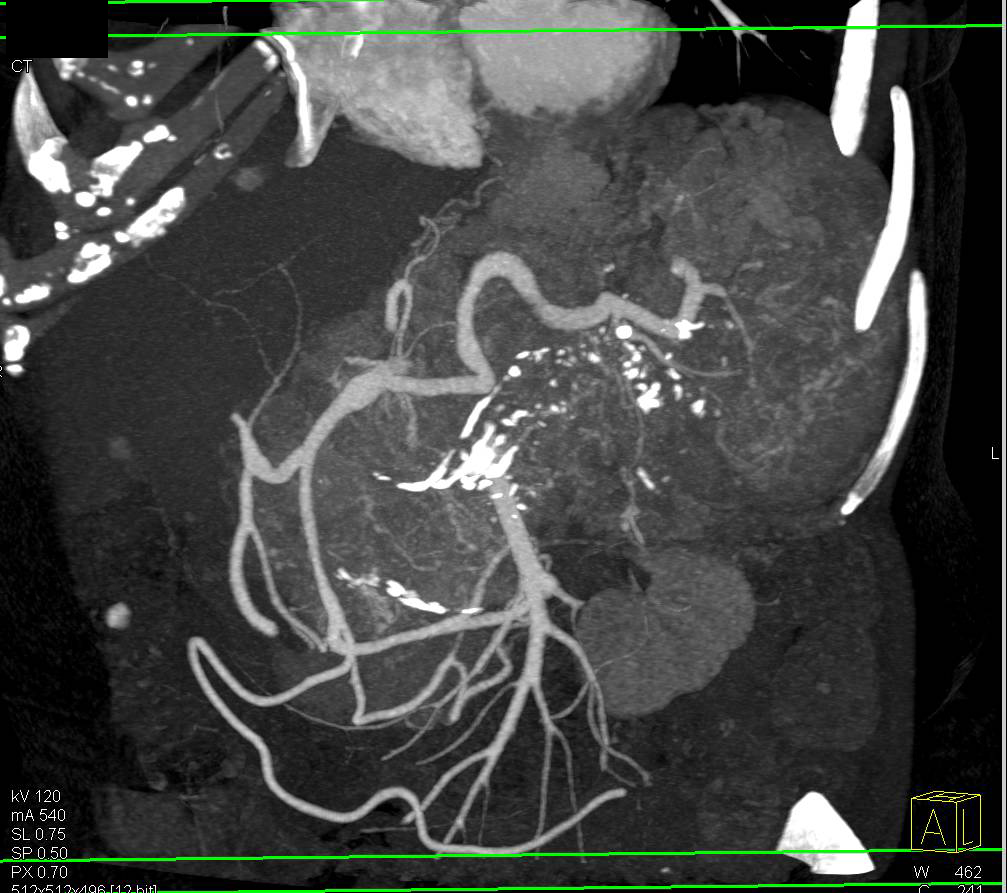 Neuroendocrine Tumor of the Pancreas with Venous Invasion - CTisus CT Scan