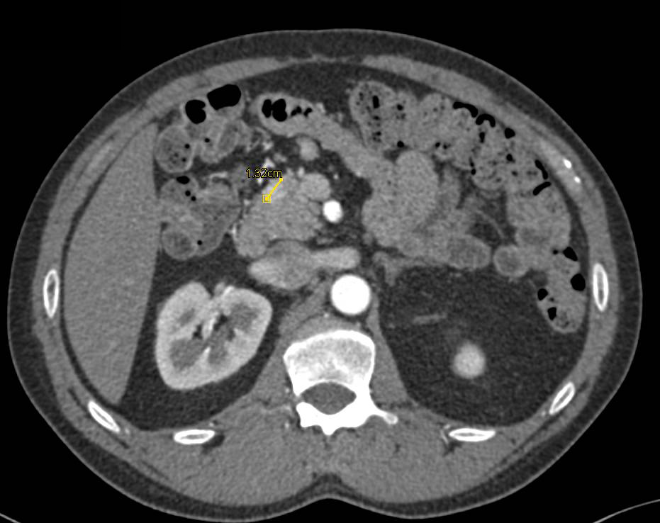 Metastatic Renal Cell Carcinoma to the Pancreas - CTisus CT Scan
