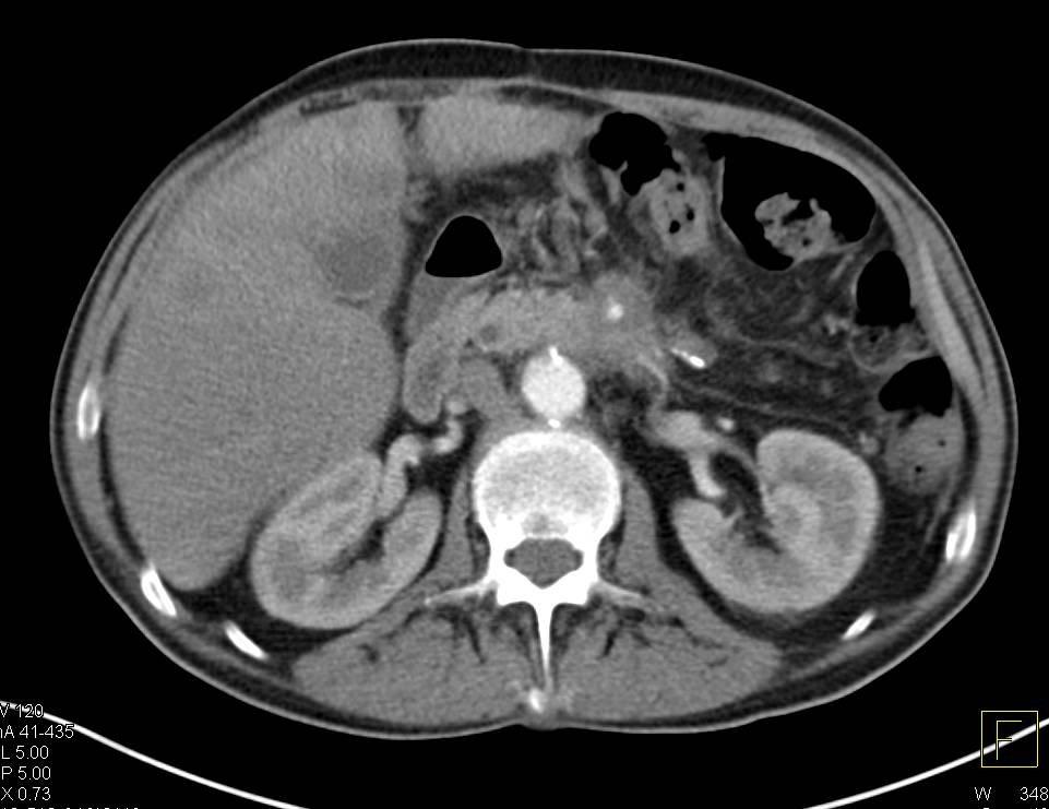 Pancreatic Cancer with Liver and Lung Metastases - CTisus CT Scan