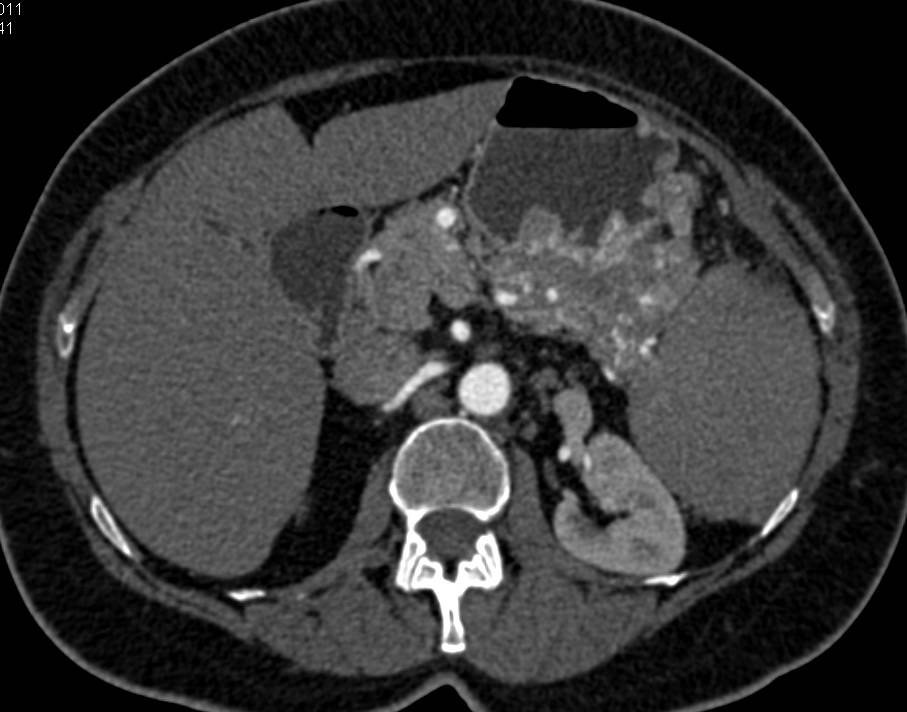 Neuroendocrine Tumor of the Tail of the Pancreas with Vascular Invasion - CTisus CT Scan