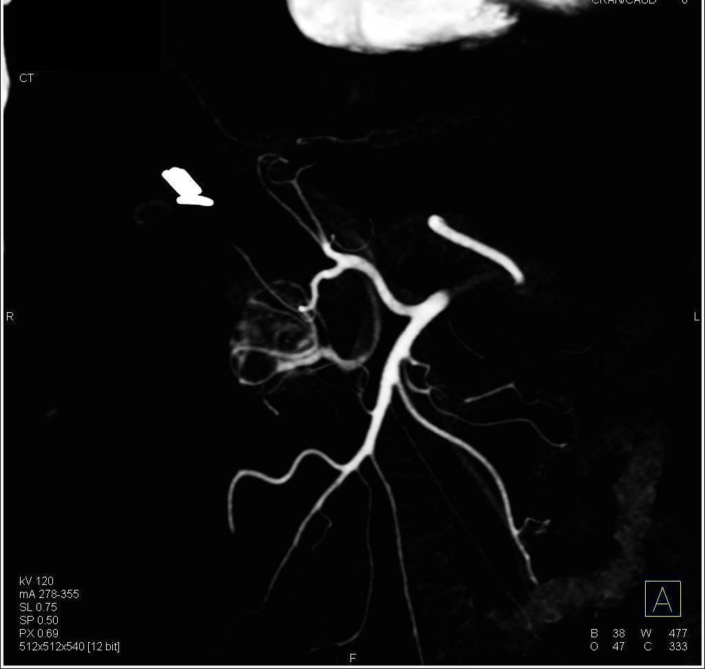 Serous Cystadenoma of the Pancreas - CTisus CT Scan