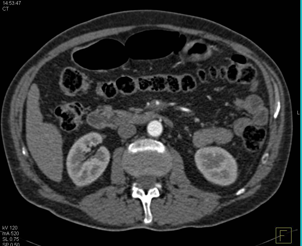 Carcinoma Uncinate Process of the Pancreas with Incidental Pulmonary Embolism (PE) and Infarction - CTisus CT Scan