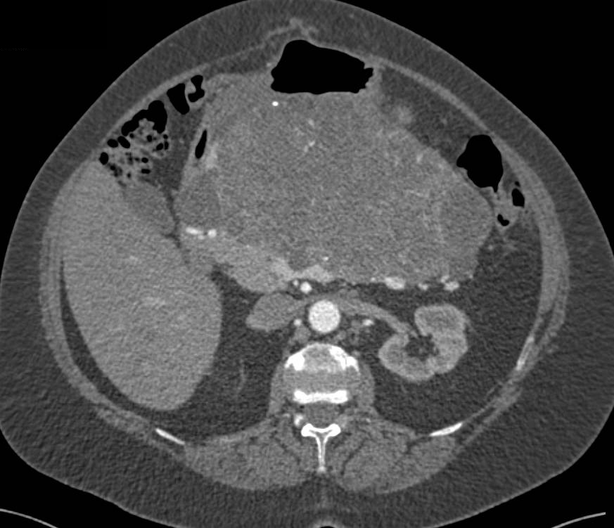 Pancreatic Serous Cystadenoma with Central Calcification - CTisus CT Scan