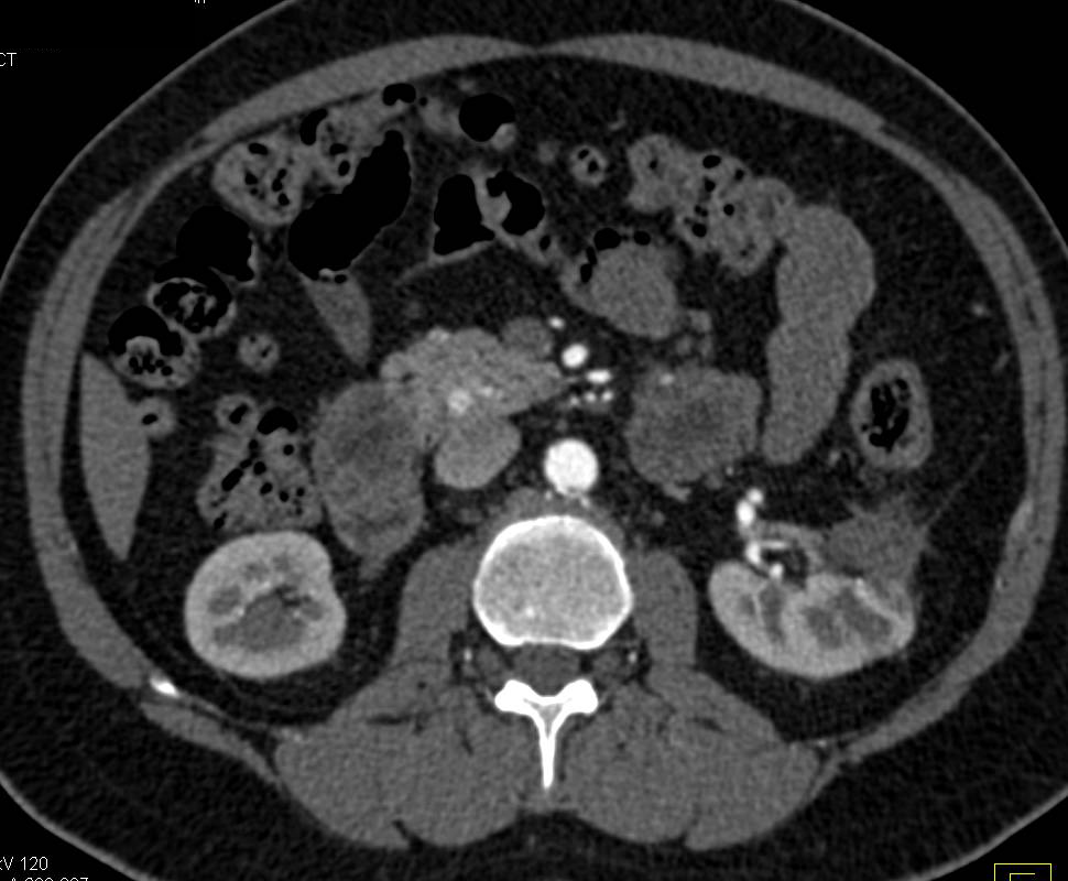 5mm Vascular Metastases from Renal Cell Carcinoma to the Head of the Pancreas - CTisus CT Scan