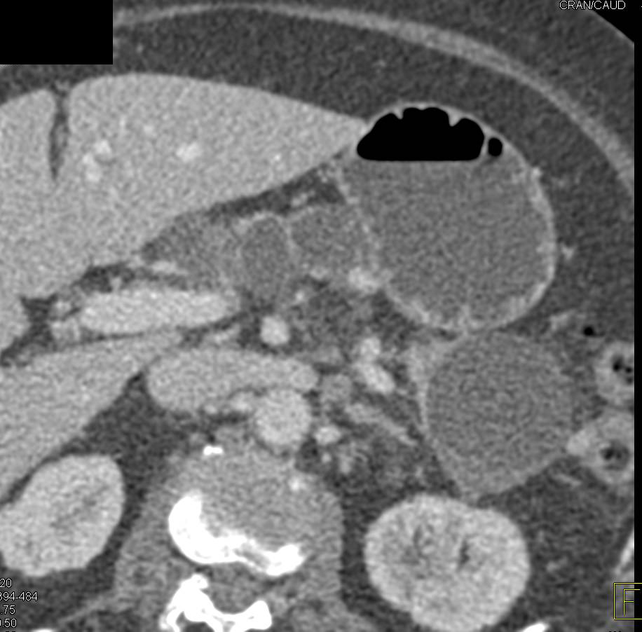 Multiple Pancreatic Cysts - CTisus CT Scan