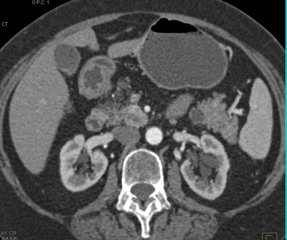 Carcinoma of the Uncinate Process - CTisus CT Scan