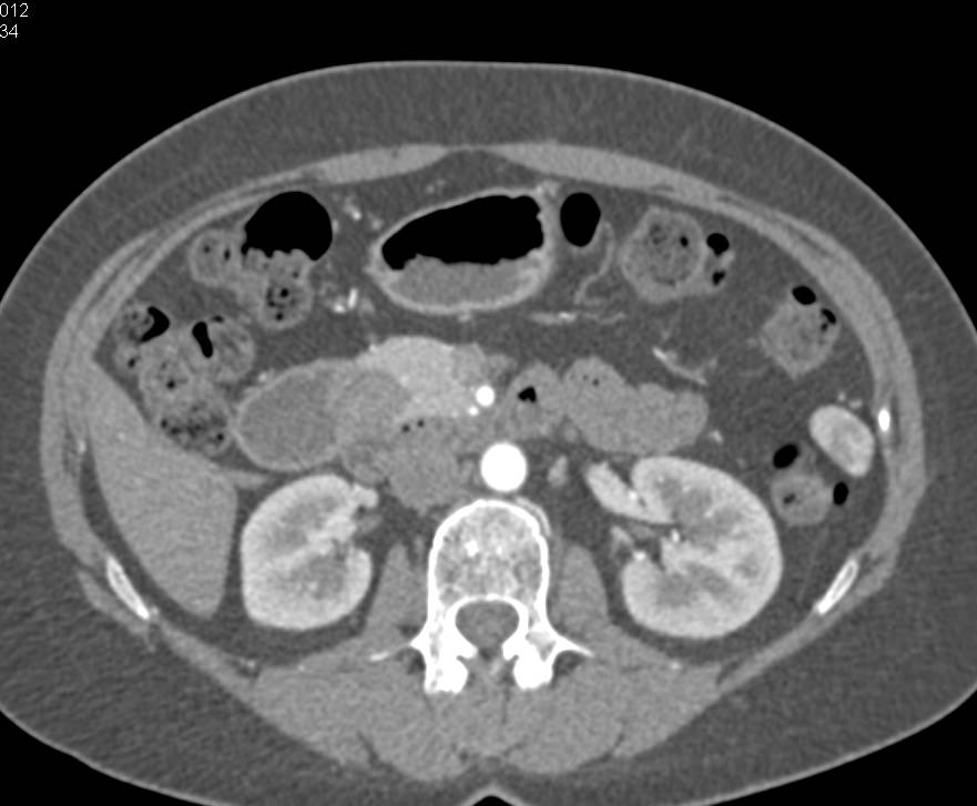 Annular Pancreas - CTisus CT Scan