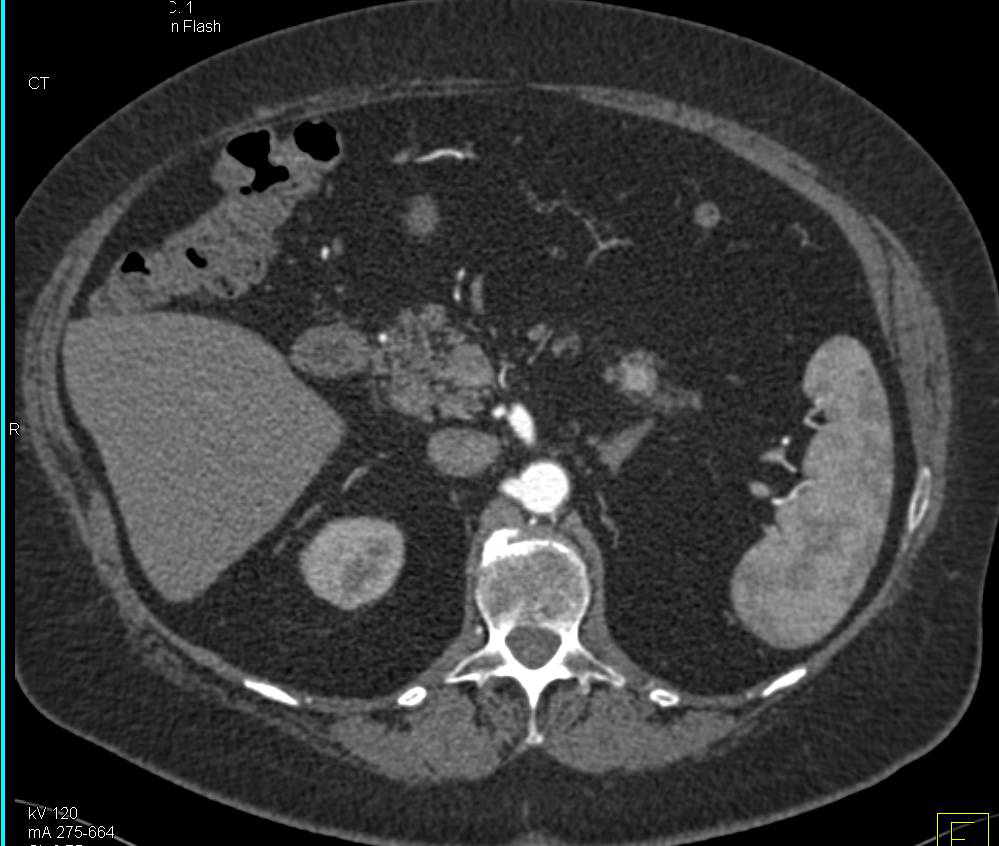 Metastatic Renal Cell Carcinoma to the Pancreas with Vascular Metastases - CTisus CT Scan