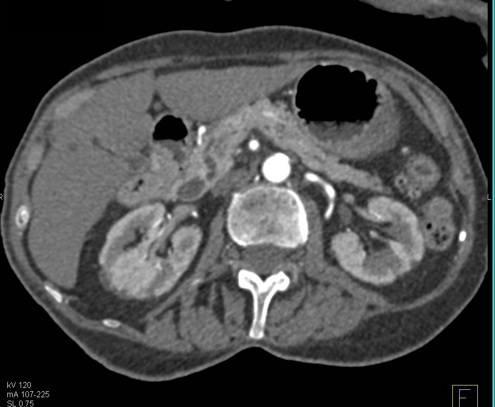 Double Duct Sign with Ampullary Stenosis - CTisus CT Scan