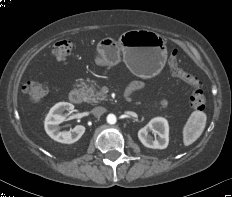Ampullary Neuroendocrine Tumor - CTisus CT Scan