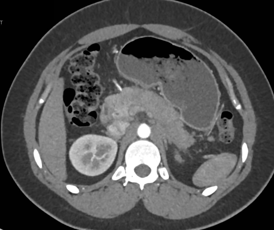 Autoimmune Pancreatitis - CTisus CT Scan