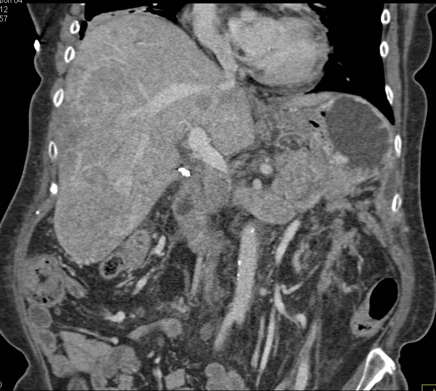 Pancreatic Cancer with Liver Metastases - CTisus CT Scan