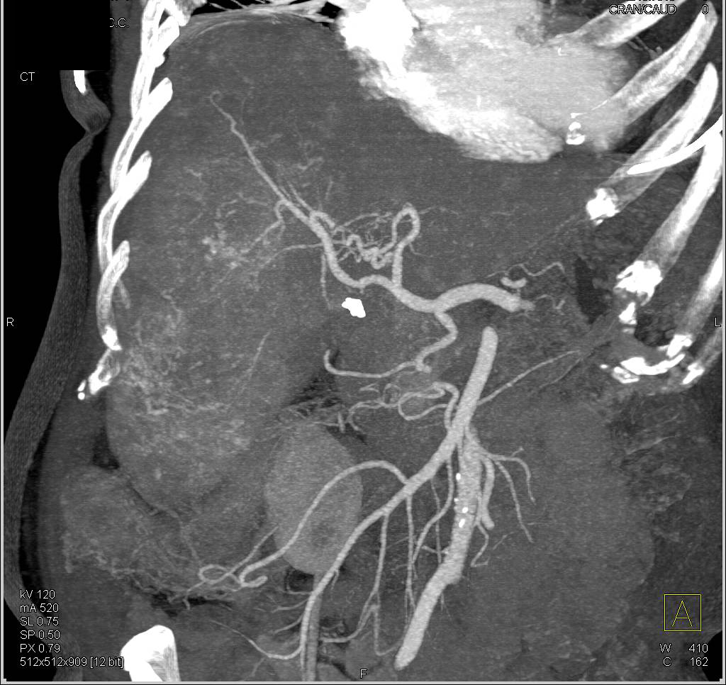 Neuroendocrine Tumor in the Tail of the Pancreas Vascular Liver Metastases - CTisus CT Scan