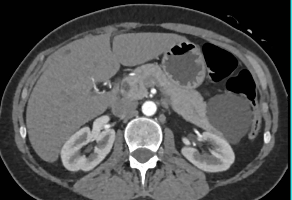 Lymphoepithelial Cyst of the Tail of the Pancreas - CTisus CT Scan