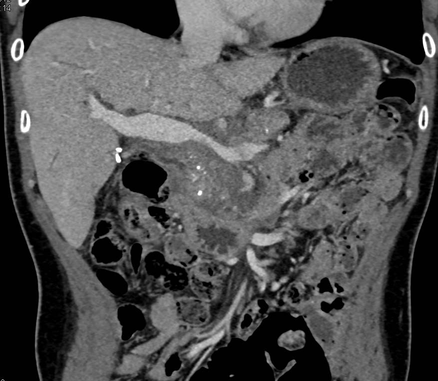 Chronic Pancreatitis with Narrowed Portal Vein - CTisus CT Scan