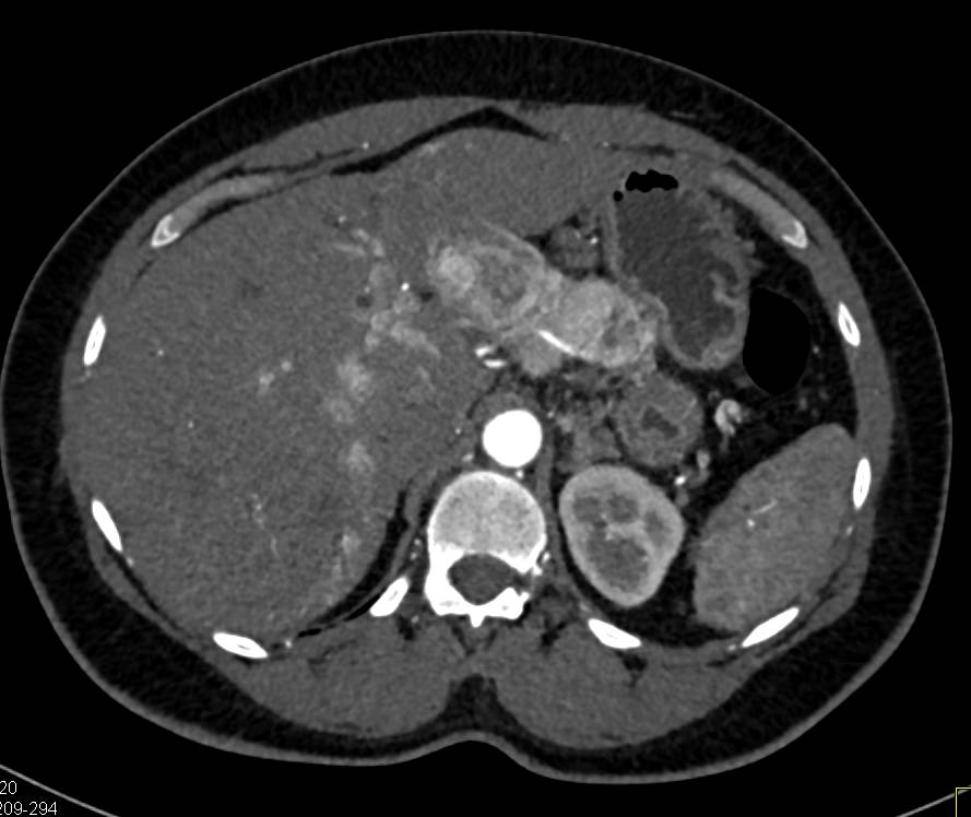 Neuroendocrine Tumor in the Body of the Pancreas with Portal Vein Invasion - CTisus CT Scan