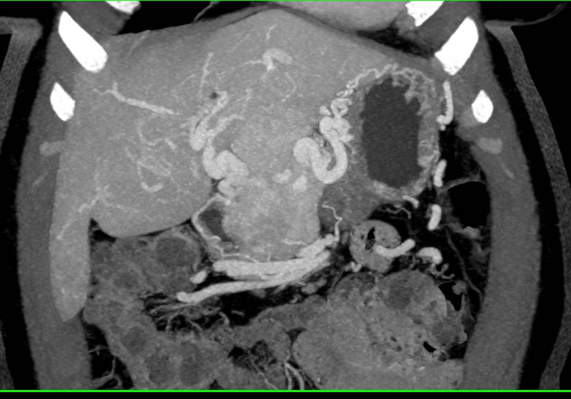 Neuroendocrine Tumor in the Body of the Pancreas with Portal Vein Invasion - CTisus CT Scan