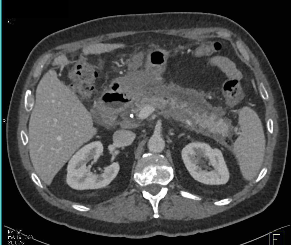 Acute Pancreatitis with Pancreatic Necrosis - CTisus CT Scan