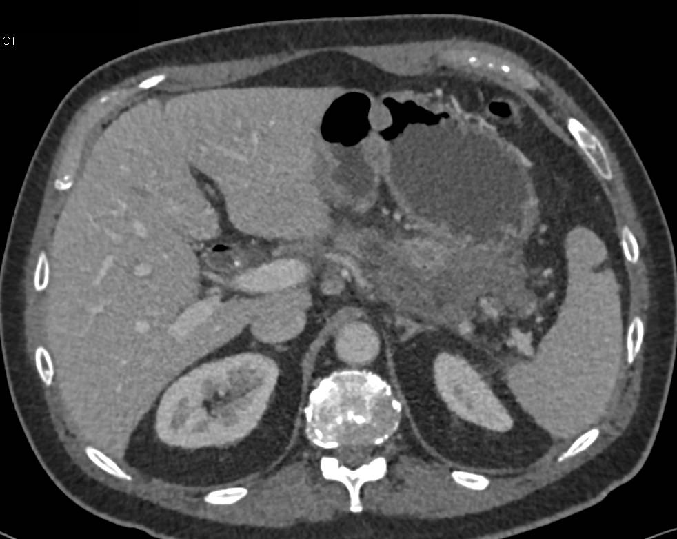 Pancreatic Necrosis Following Stent Placement - CTisus CT Scan