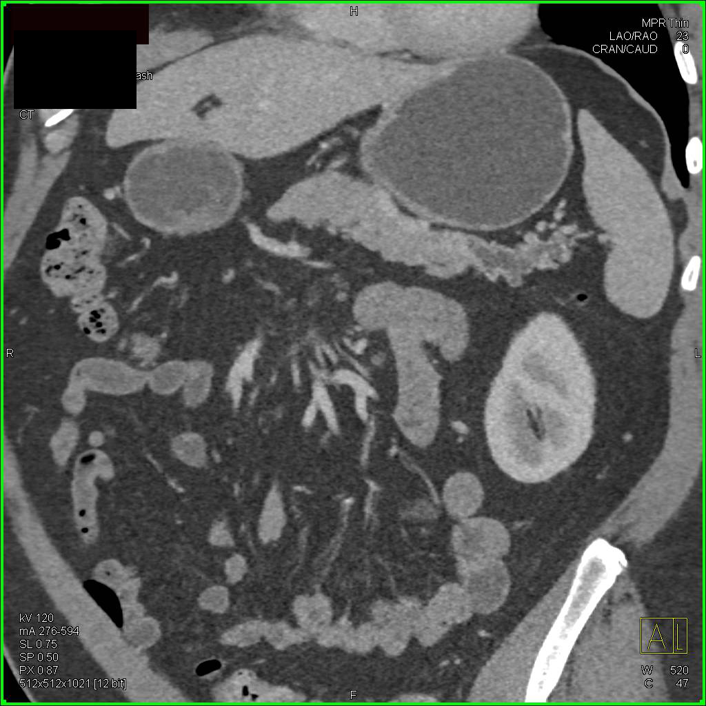 Subtle Pancreatic Cancer Defined by Dilated Pancreatic Duct - CTisus CT Scan