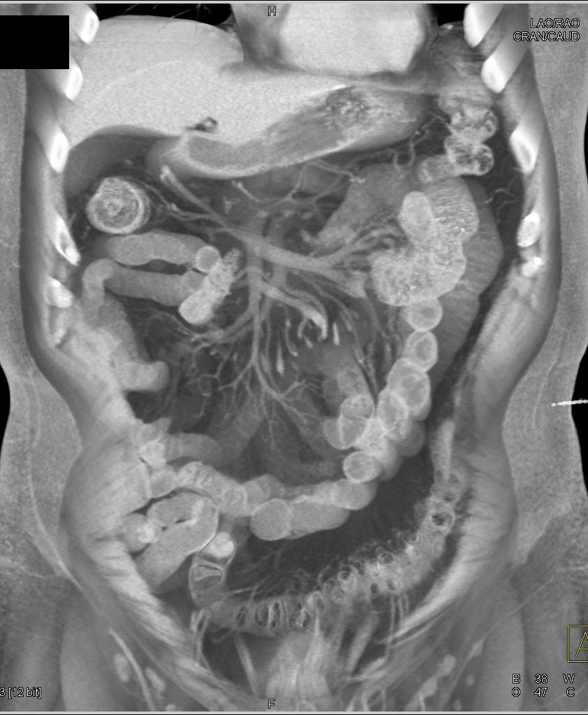 Metastatic Recurrent Renal Cell Carcinoma to the Head of the Pancreas - CTisus CT Scan