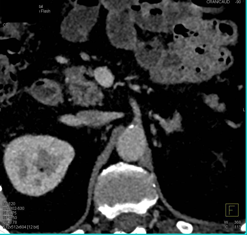 Focal Fat in Pancreatic Head - CTisus CT Scan