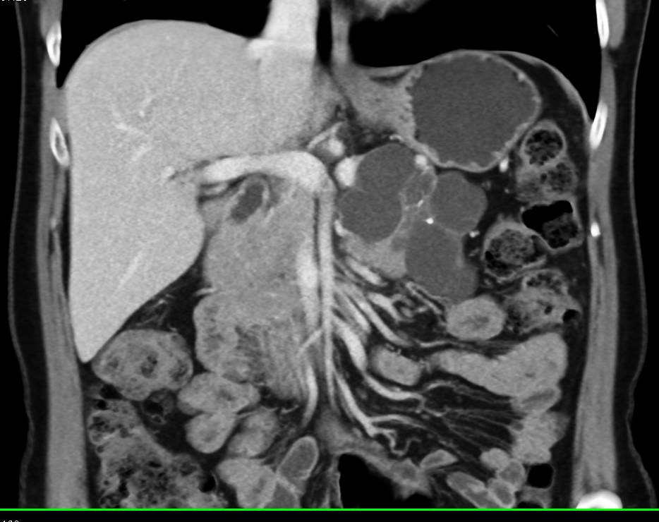 Serous Cystadenoma with Central Calcification and Septations - CTisus CT Scan
