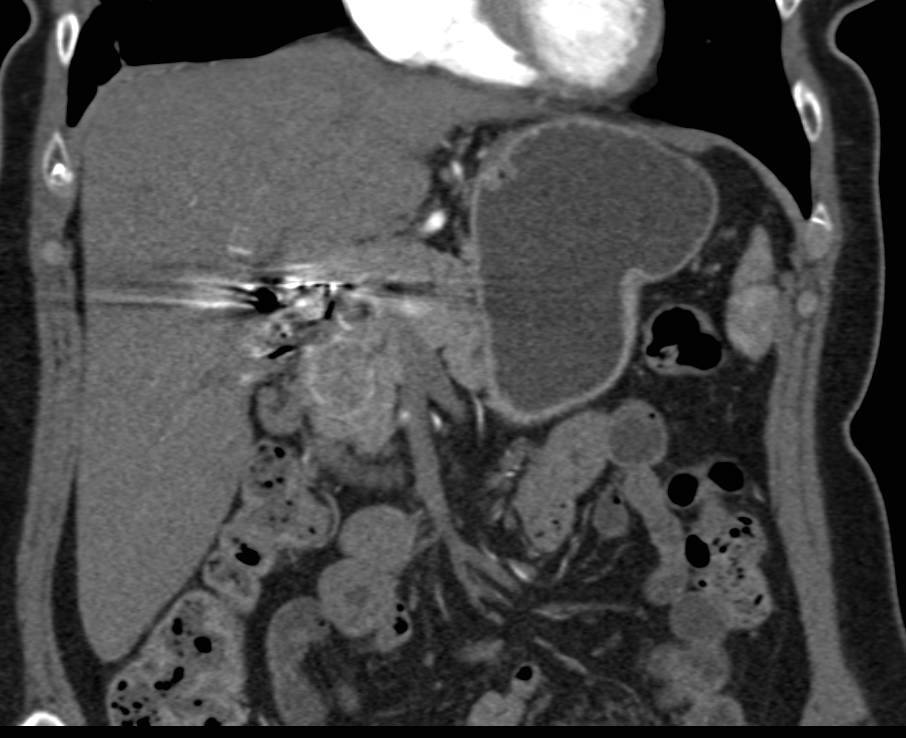 Cystic Neuroendocrine Tumor Head of Pancreas - CTisus CT Scan