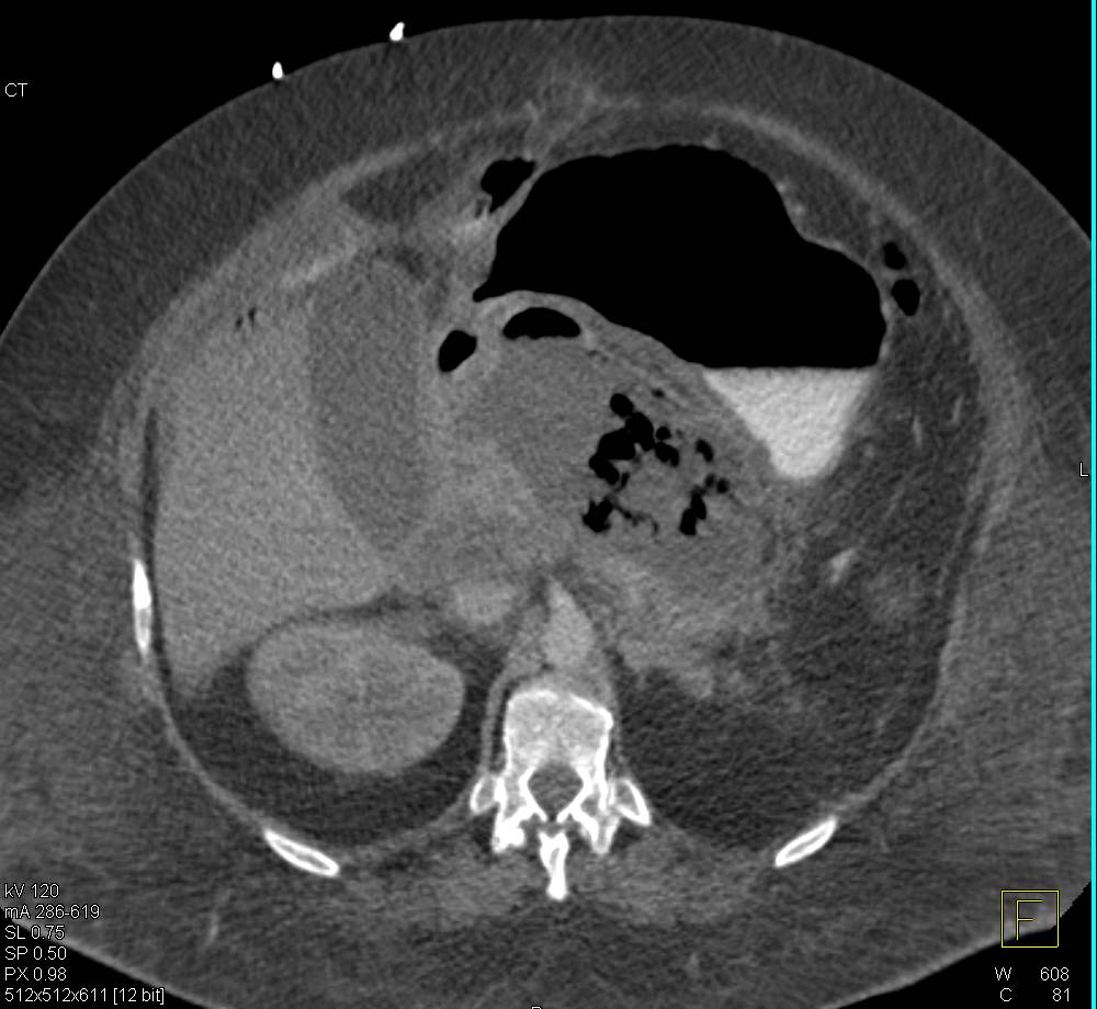 Pancreatic Necrosis with Pancreatic Abscess - CTisus CT Scan