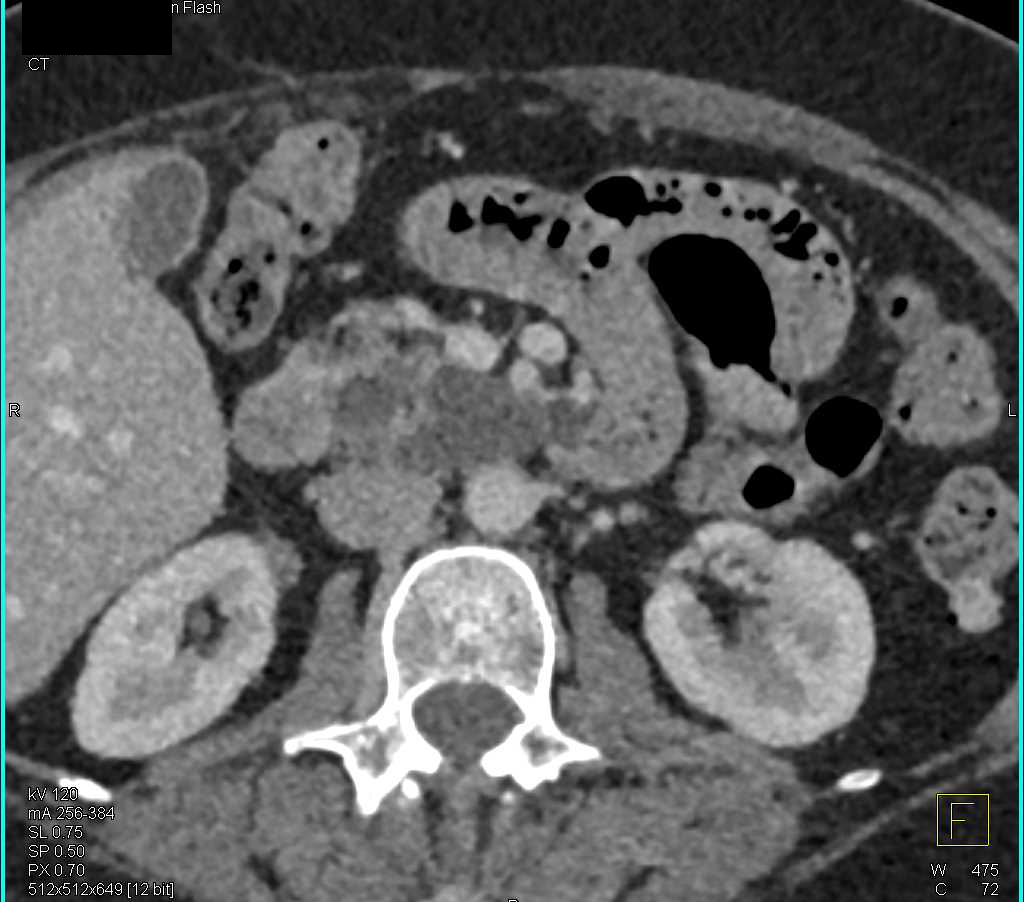 Serous Cystadenoma - CTisus CT Scan