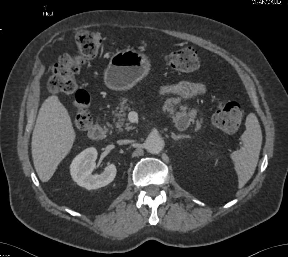Fatty Infiltration of the Pancreas - CTisus CT Scan