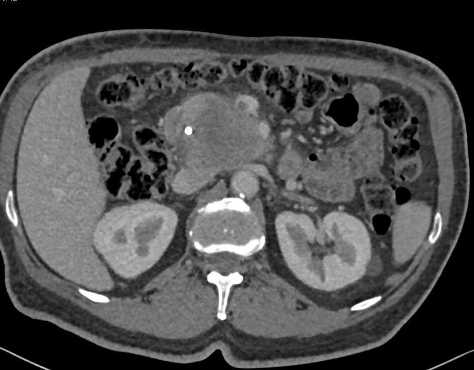 Pancreatic Cancer Invades the Portal Vein - CTisus CT Scan