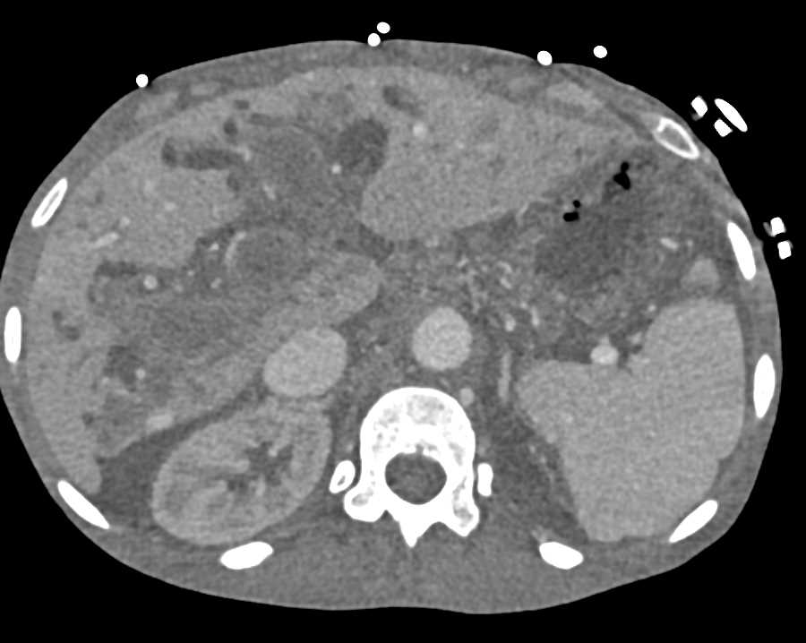 Pancreatic Cancer with Invasion of Portal vein and Porta Hepatis and Lung Metastases - CTisus CT Scan