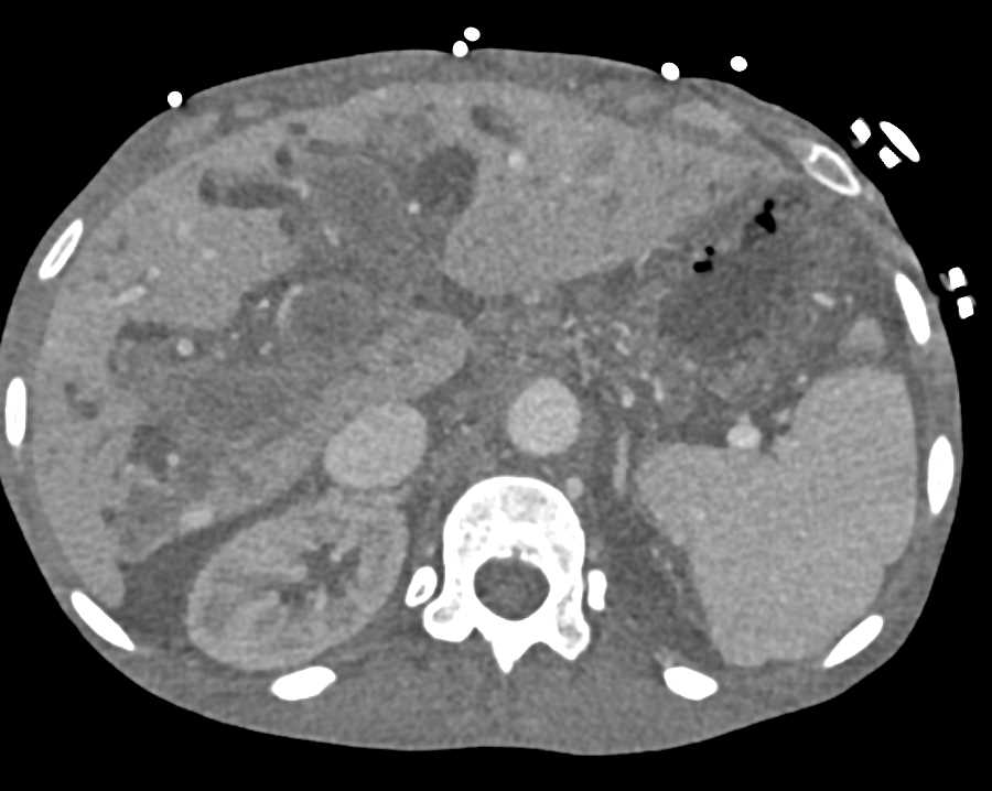 Pancreatic Cancer with Invasion of Portal vein and Porta Hepatis and Lung Metastases - CTisus CT Scan