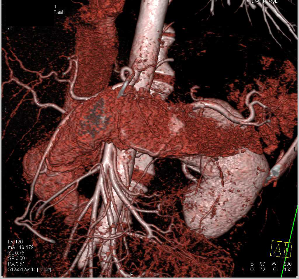 Incidental Neuroendocrine Tumor in the Body/Tail of the Pancreas - CTisus CT Scan