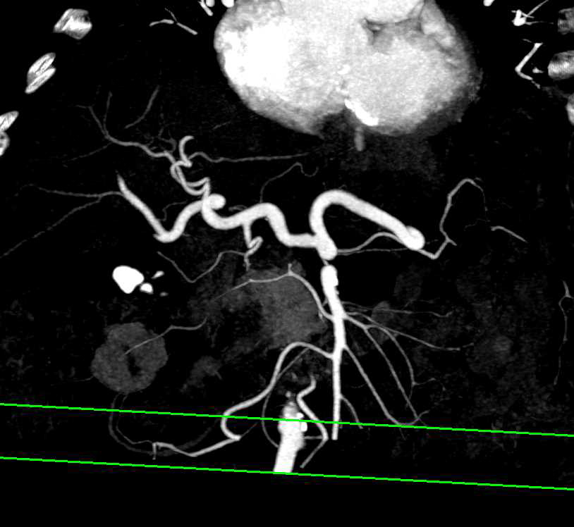 Pancreatic Cancer with Arterial and Venous Involvement - CTisus CT Scan