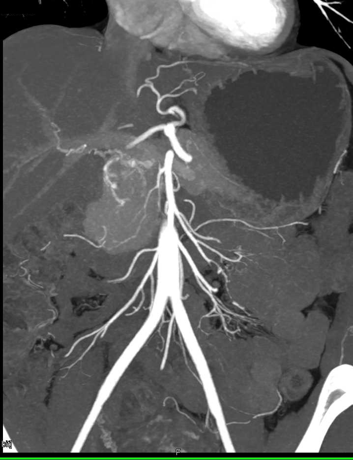 Serous Cystadenoma of the Head of the Pancreas - CTisus CT Scan