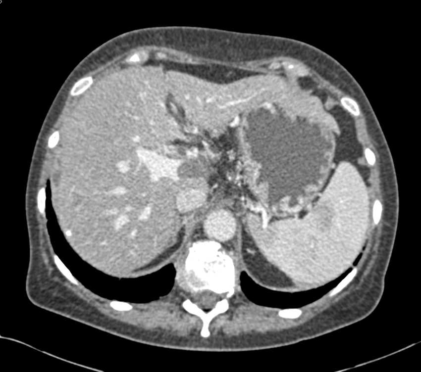 Pancreatic Cancer Invades the Portal Vein, Splenic Vein and Superior Mesenteric Vein (SMV) - CTisus CT Scan